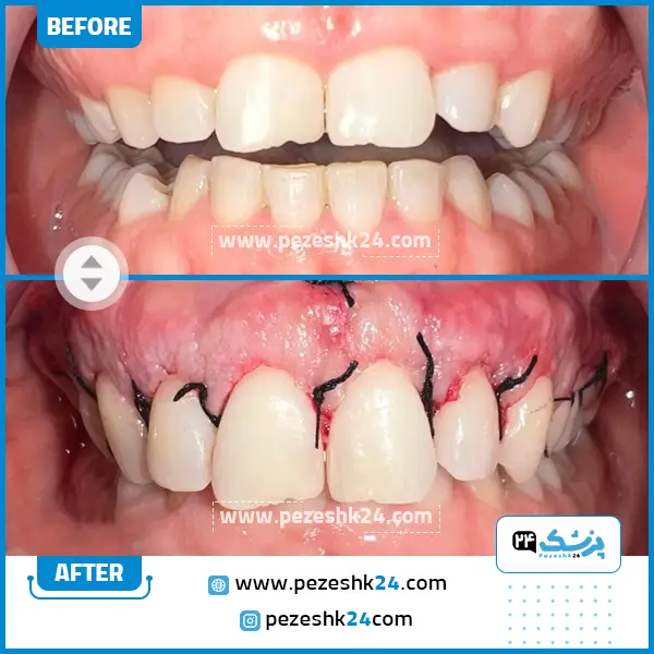 قبل و بعد از جراحی لثه دکتر فاضلی