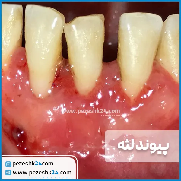 پیوند لثه دکتر فاضلی