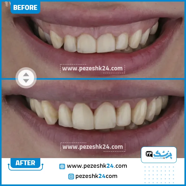 قبل و بعد جراحی لثه دکتر هاوش غارتی