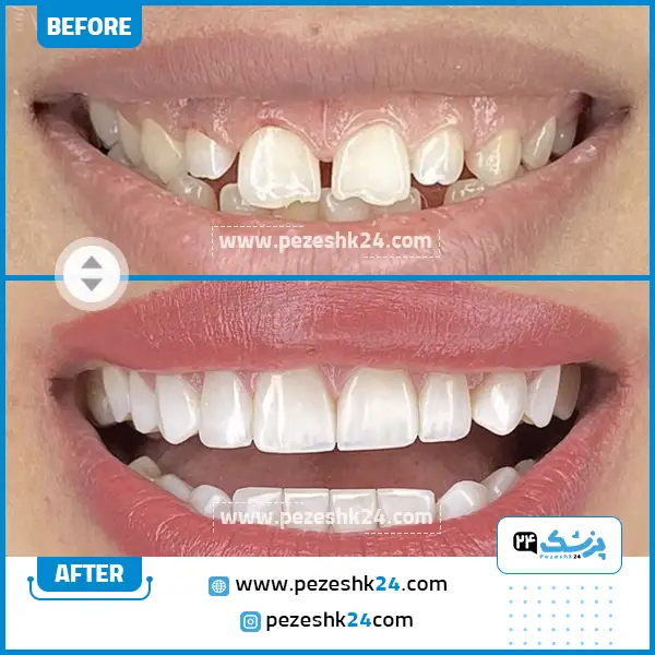 قبل و بعد جراحی لثه دکتر هاوش غارتی تهران