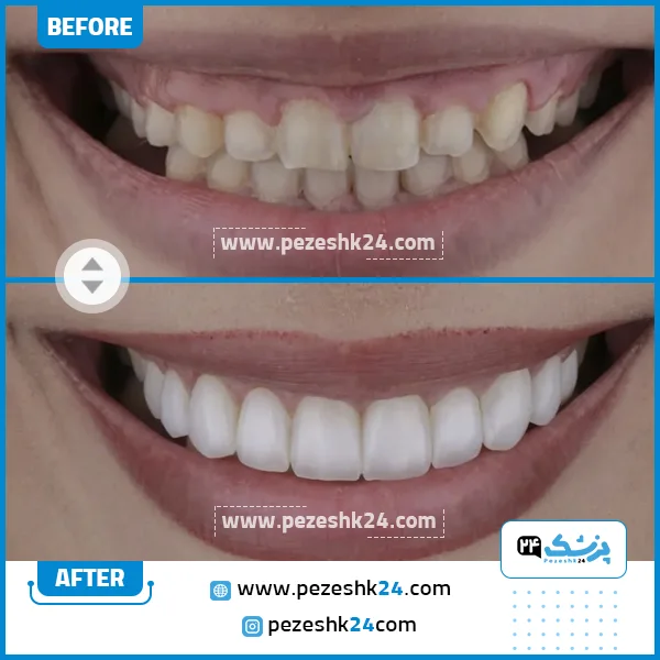 قبل و بعد جراحی لثه دکتر غارتی