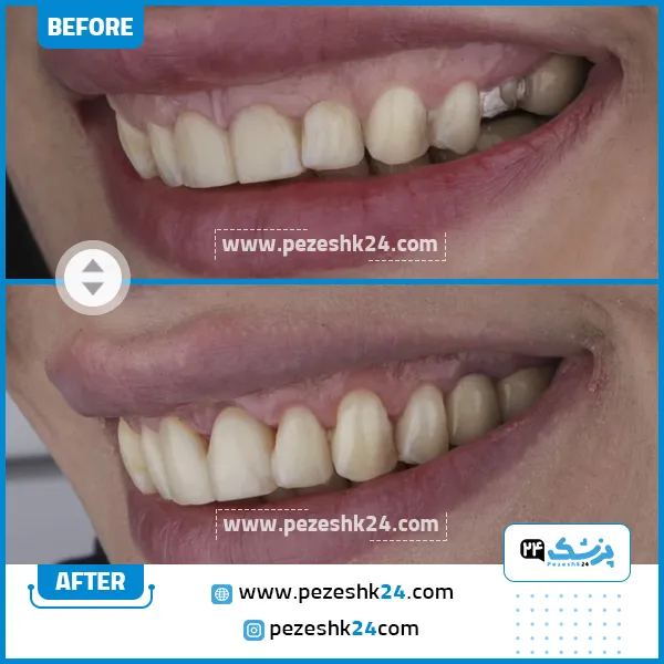 قبل و بعد جراحی لثه دکتر غارتی در تهران