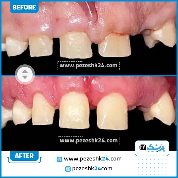 قبل و بعد جراحی لثه دکتر اخوان رسول زاده