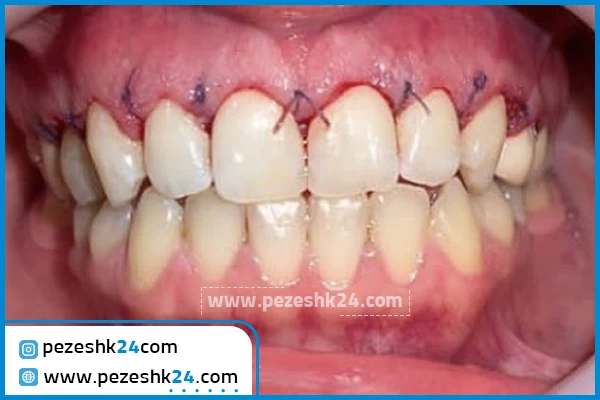 قبل و بعد جراحی لثه دکتر رسول زاده