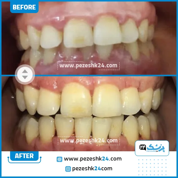 قبل و بعد جراحی لثه دکتر اخوان رسول زاده تهران