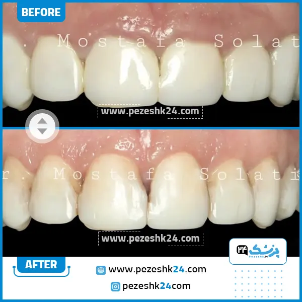 قبل و بعد جراحی لثه دکتر صولتی