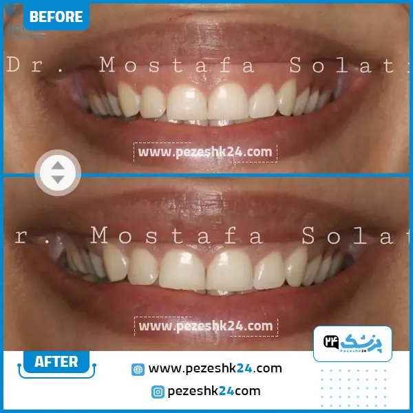 قبل و بعد جراحی لثه دکتر مصطفی صولتی