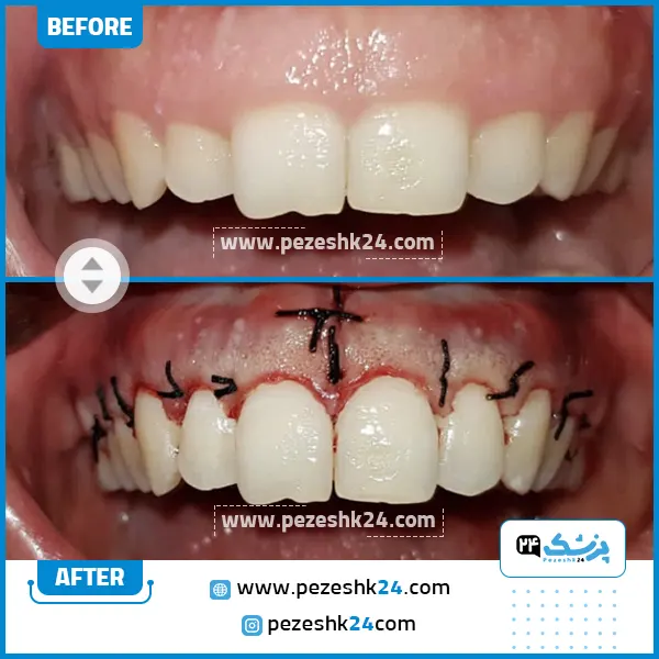 قبل و بعد جراحی لثه دکتر مصطفی صولتی در تهران