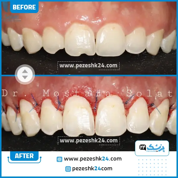 قبل و بعد لیفت لثه دکتر صولتی