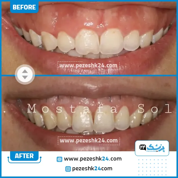 لیفت لثه در تهران