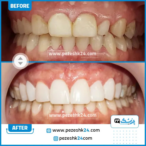 قبل و بعد جراحی لثه دکتر ضرابی در مشهد