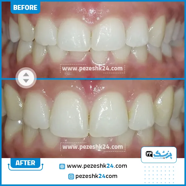 قبل و بعد جراحی لثه دکتر ضرابی مشهد