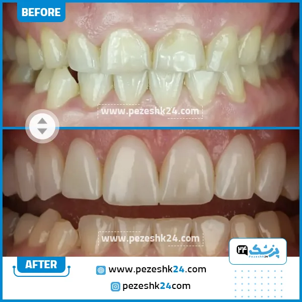 قبل و بعد لیفت لثه دکتر ضرابی