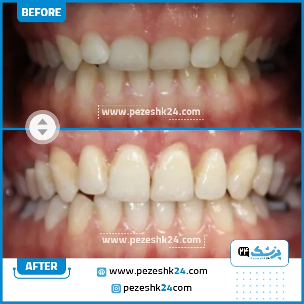 قبل و بعد جراحی لثه دکتر ضرابی