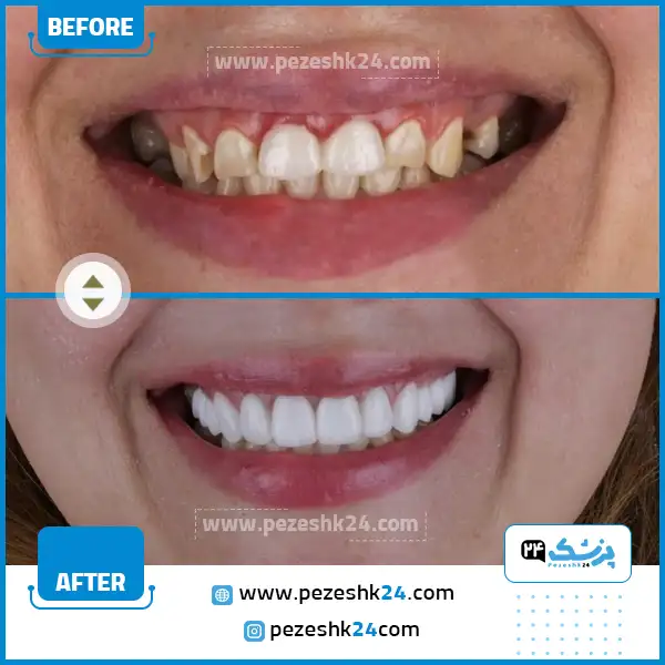 قبل و بعد از جراحی لثه در مشهد