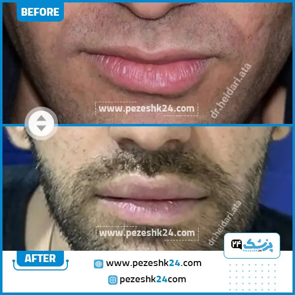 عکس قبل و بعد لیفت لب دکتر حیدری