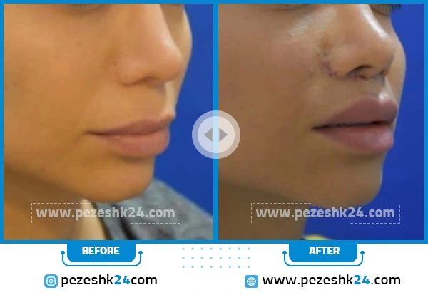 قبل و بعد جراحی لیفت لب دکتر صلاحی تهران
