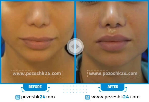 قبل و بعد جراحی سانترال لب دکتر صلاحی