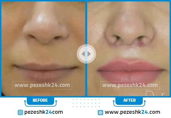 قبل و بعد از جراحی سانترال لب دکتر صلاحی