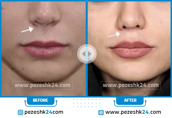 قبل و بعد لیفت لب دکتر بیات