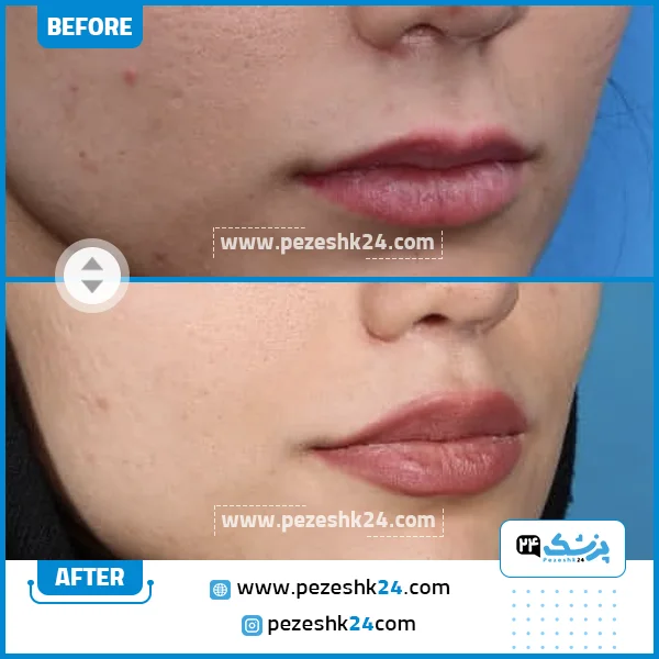 قبل و بعد لیفت لب دکتر بیات تهران