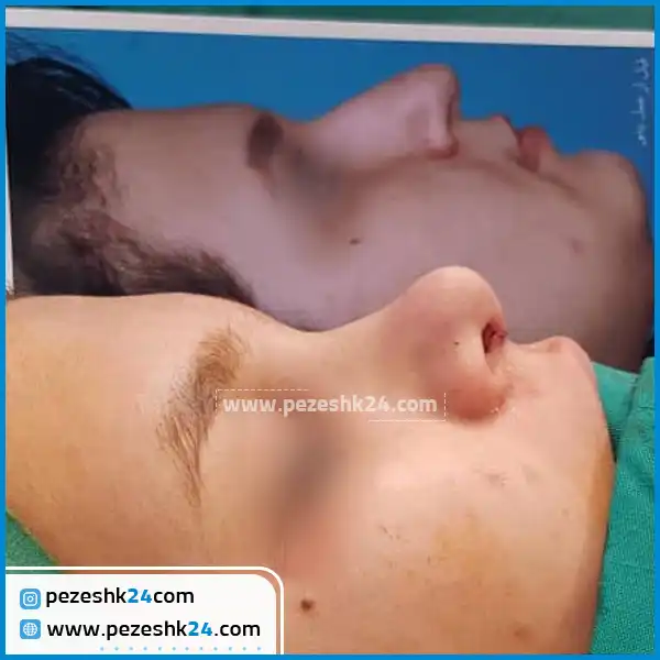 قبل و بعد از جراحی بینی دکتر آقاجانپور اراک