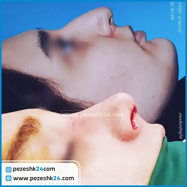 قبل و بعد عمل زیبایی بینی دکتر آقاجانپور