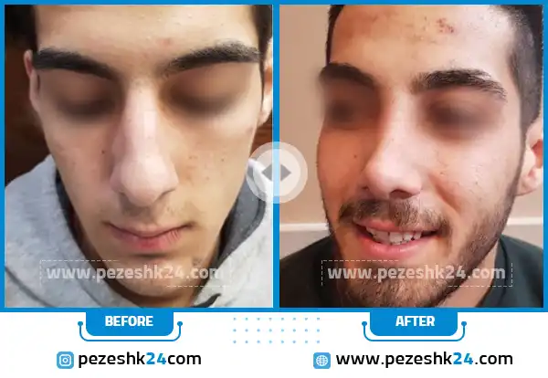 قبل و بعد جراحی زیبایی بینی دکتر آقاجانپور در اراک