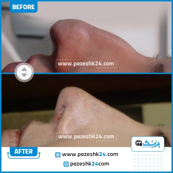 قبل و بعد عمل بینی دکتر قربانی