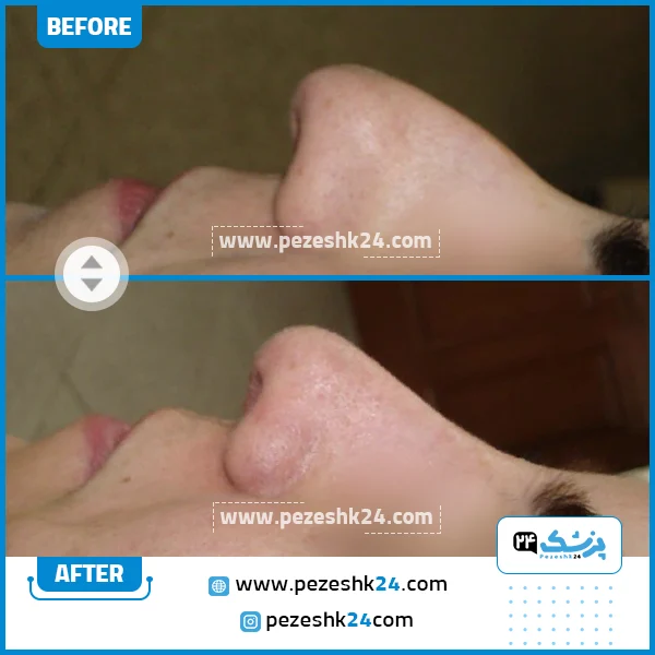 قبل و بعد عمل بینی دکتر قربانی در مشهد