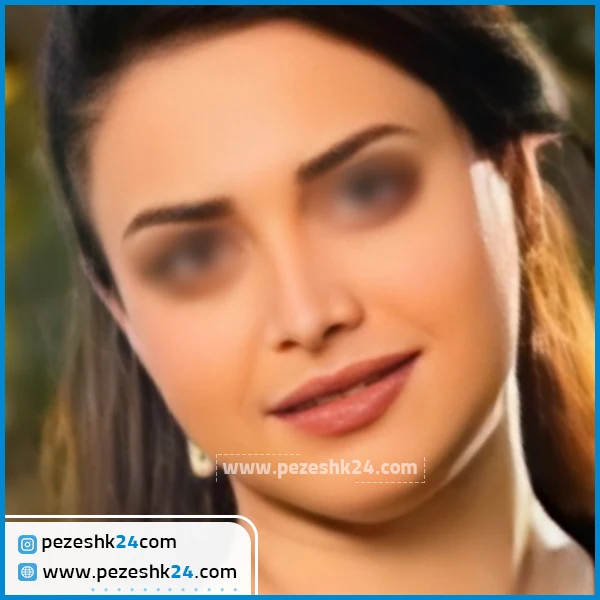 عمل زیبایی بینی دکتر کشاورزمنش