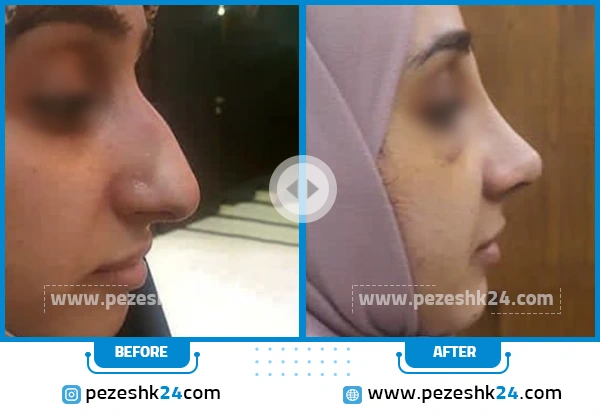 قبل و بعد عمل بینی دکتر کشاورزمنش مشهد