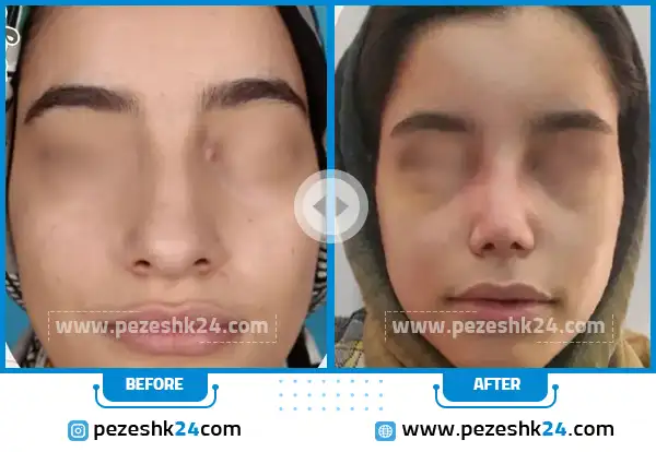 قبل و بعد از جراحی بینی دکتر راکعی