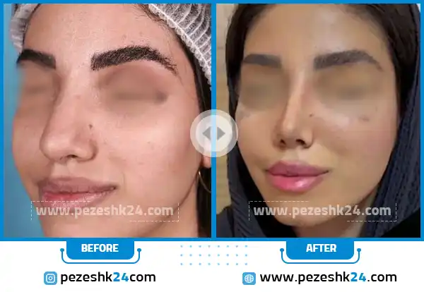 قبل و بعد از جراحی بینی دکتر راکعی اراک