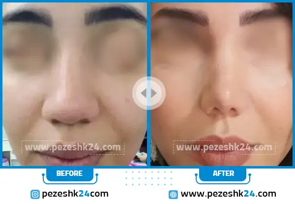 قبل و بعد از جراحی بینی دکتر سیامک راکعی