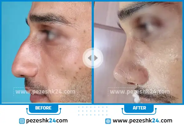 قبل و بعد عمل بینی دکتر راکعی