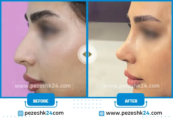 قبل و بعد از جراحی بینی اراک