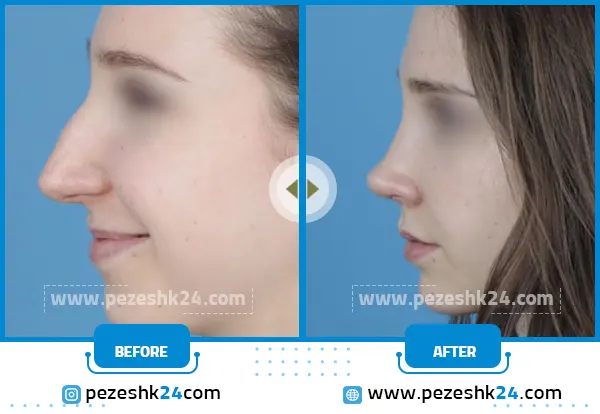 قبل و بعد عمل بینی در اراک