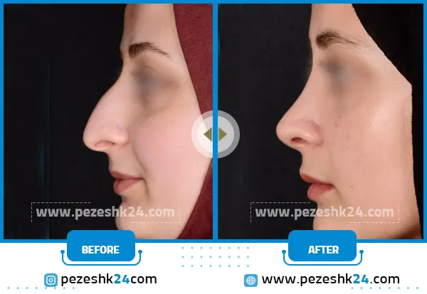 عمل بینی در اراک