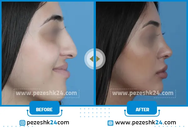 عمل زیبایی بینی در اراک