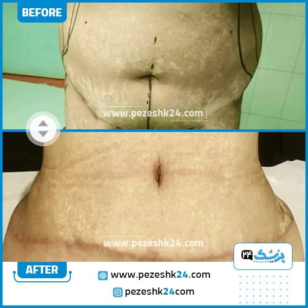 قبل و بعد پیکرتراشی دکتر برجسته