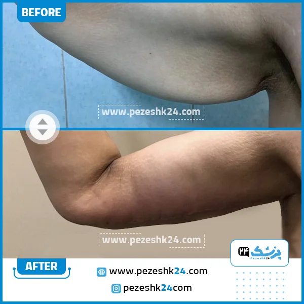 پیکرتراشی بازو با دکتر رضایی