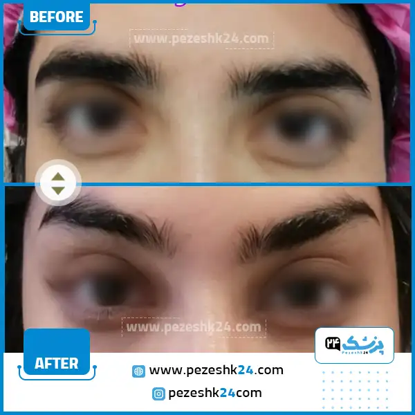 عکس قبل و بعد لیفت شقیقه