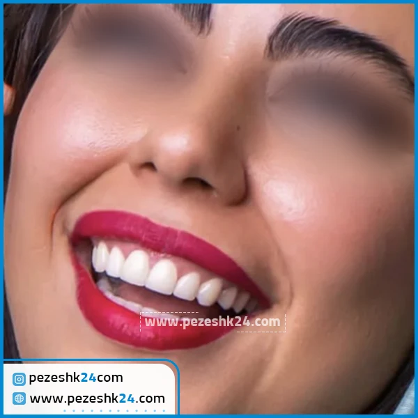 نمونه لیفت لثه دکتر طلیعی