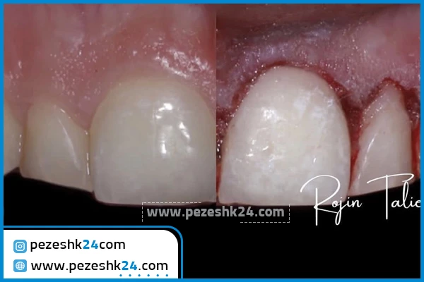 لیفت لثه دکتر طلیعی تهران