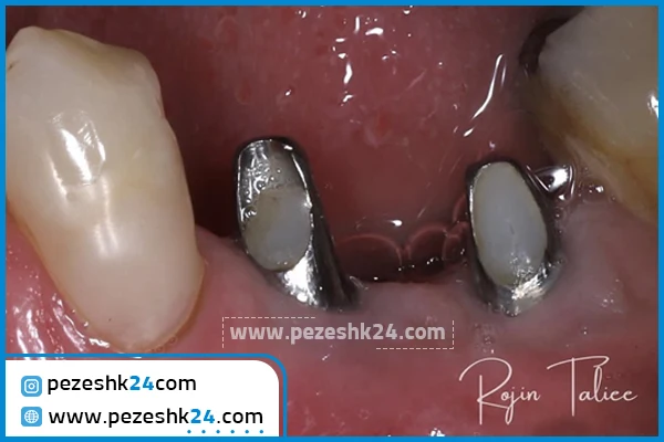 لیفت لثه دکتر طلیعی در تهران