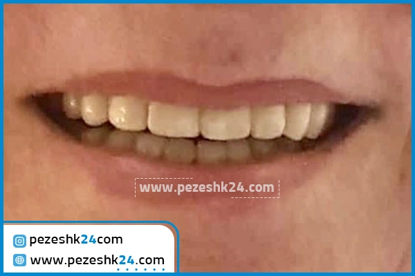 امیپلنت دندان دکتر فاضلی تهران