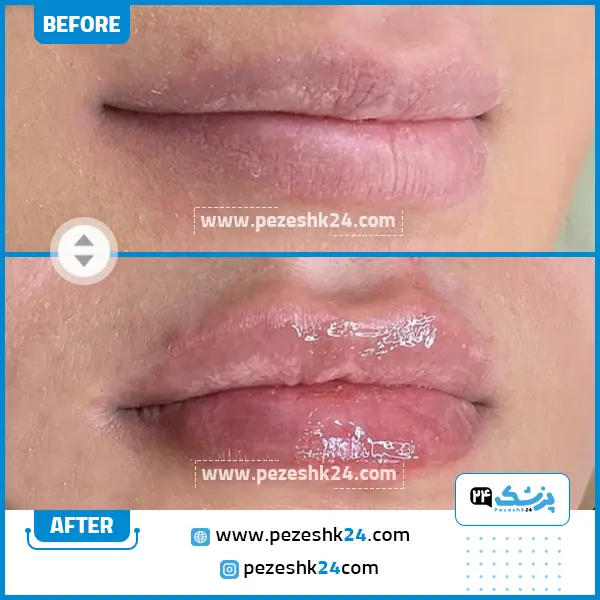 قبل و بعد تزریق ژل لب دکتر کسگری