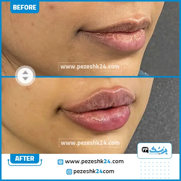 قبل و بعد از تزریق ژل لب دکتر سلطانی