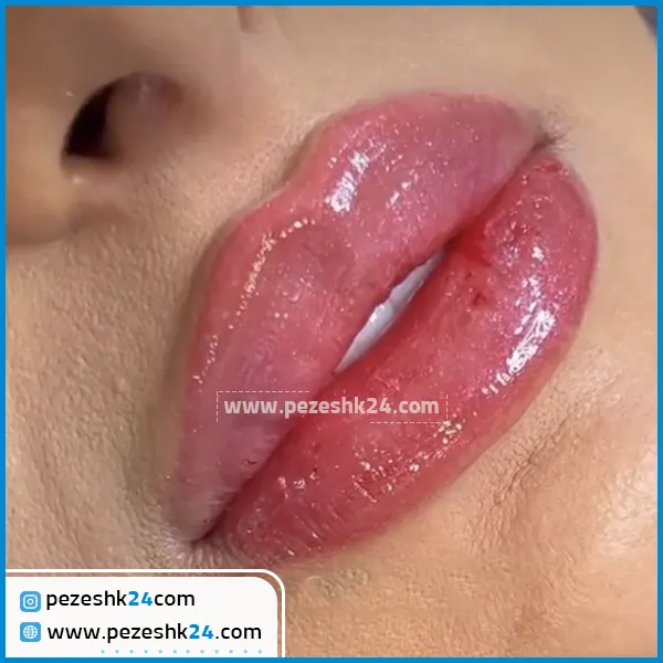 قبل و بعد از تزریق ژل لب دکتر سلطانی تهران